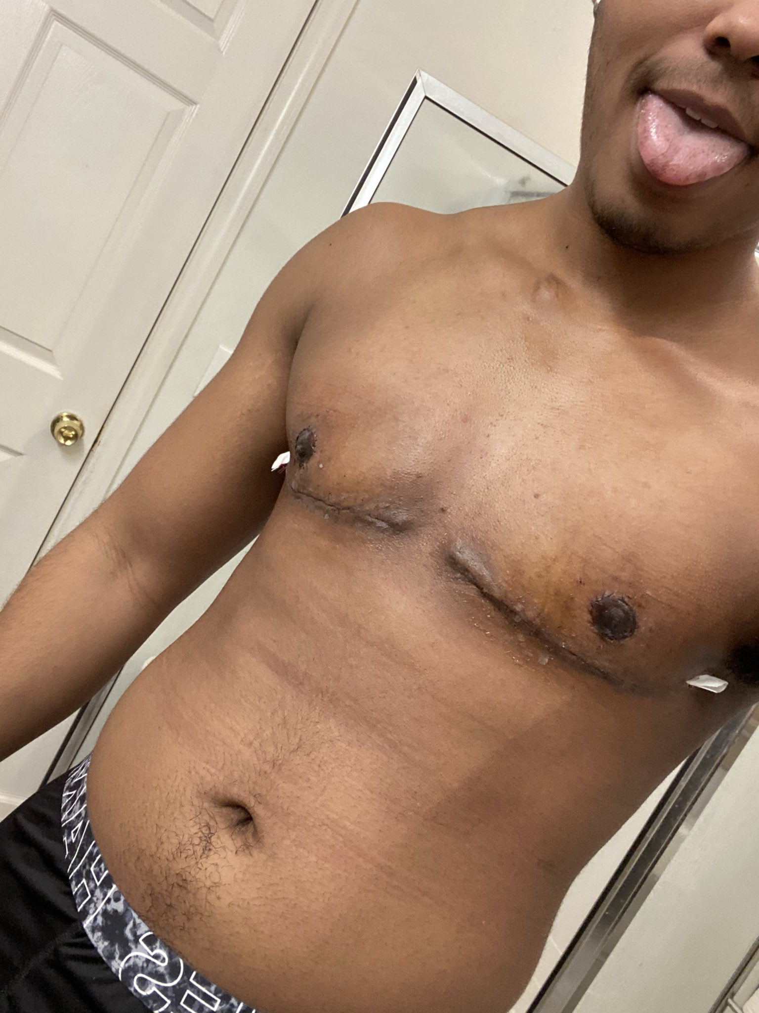 Trans Man displays his chest after removing his breast through surgery - Photos 2